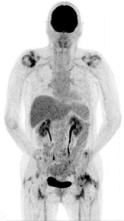 PET/CT scans showing: (a) PMR patient (cerebral and urinary tract 18-18F-FDG uptake are