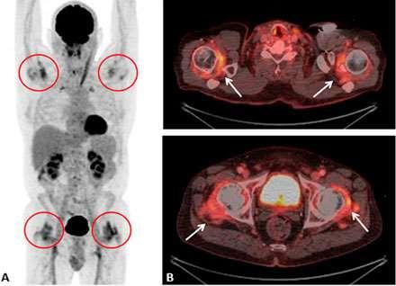 PET-CT findings in patients with polymyalgia rheumatica without symptoms of cranial ischaemia.