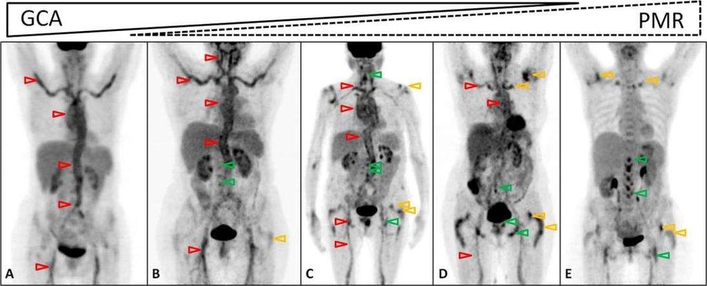18F-FDG PET/CT in polymyalgia rheumatica a pictorial review. Br J Radiol 2017; 90 : 20170198 Figure 5.