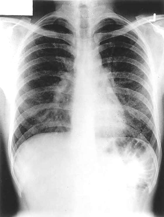 A:Chest radiograph of a patient with pigeon breeder s disease with fever, dyspnea, and bibasilar rales.