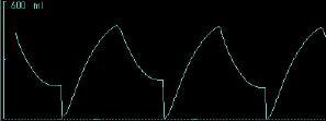 Volume Waveform Air-Trapping or Leak Loss of volume If the exhalation side of the waveform doesn t return