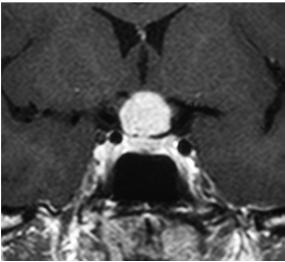 MRI depicts a suprasellar, nodular mass, arising from pituitary stalk, isointense on T1 and T2 