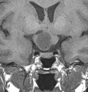 Diagnostic Evaluation of the Lesions of the Sellar and Parasellar Region 111 The childhood variety, occurring within the first decade of life, is typically pilocytic astrocytoma (WHO grade I), a