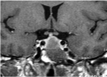 Diagnostic Evaluation of the Lesions of the Sellar and Parasellar Region 115 Hypopituitarism is less frequent, both for the above described anatomical reasons and because it can be clinically masked