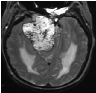 Chondromas and chondrosarcomas are centered along the lateral margin of clivus in petrooccipital fissure and display chondroid calcifications in more than half of cases.