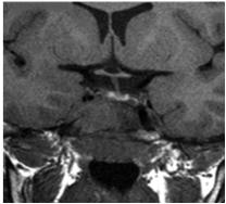 On MRI there is no specific sign but in all patients with DI the bright spot of the posterior pituitary is lost. In addition a suprasellar mass, hypothalamic lesions, and a thickened stalk (> 3.
