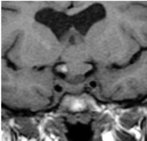 As a result, these tumors can become large and cause liquoral obstruction and signs of increased intracranial pressure before the diagnosis is made.