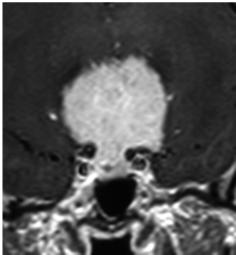 Imaging features of meningiomas are frequently characteristic and permit to distinguish them from other parasellar tumors (Smith, 2005).
