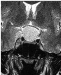 They can fill and expand the cavernous sinus; hyperostosis (thickening and sclerosis) of the contiguous bone can be present (Smith, 2005).
