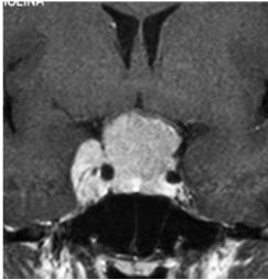 On MR meningiomas are typically isointense on T1 and T2, enhancing homogeneously and brightly, with occasional areas of diffuse calcification. Forty per cent are hyperintense on T2 (Karavitaki et al.