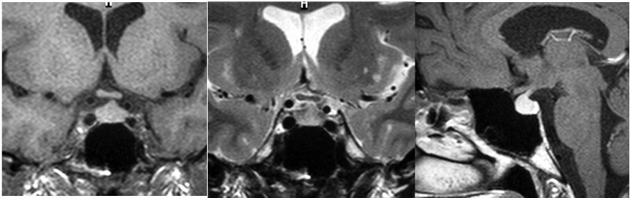 Diagnostic Evaluation of the Lesions of the Sellar and Parasellar Region 131 (reflecting extension of the process towards the pituitary stalk) along with enhancement of the diaphragma sellae
