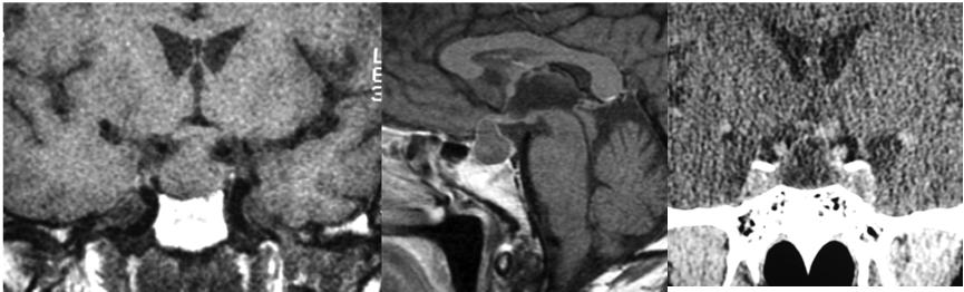 Diagnostic Evaluation of the Lesions of the Sellar and Parasellar Region 135 patients present with a chronic and indolent course with few infective manifestations, thus mimicking a pituitary tumor