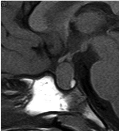 T1 MRI shows diffuse enlargement of the pituitary gland, with convex superior margin and posterior pituitary bright spot (a), homogeneously enhancing (b).