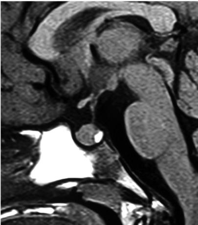 MRI at diagnosis (c) shows enlarged, homogeneously enhancing pituitary gland with suprasellar extension; after replacement treatment with L-thyroxine