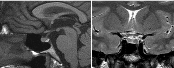 Diagnostic Evaluation of the Lesions of the Sellar and Parasellar Region 103 Imaging MRI is nowadays the gold standard for imaging pituitary gland and hypothalamic disorders.