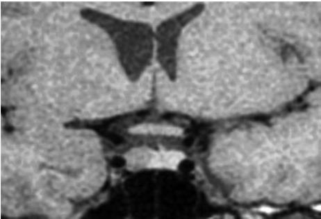 Most microadenomas on precontrast T1-weighted images show abnormal low signal, whereas some may appear hyperintense due to internal bleeding (Rumboldt, 2005).