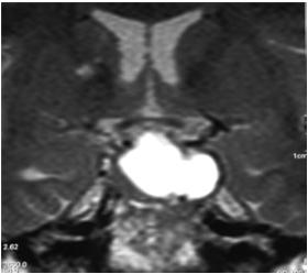 Macroadenomas are occasionally heterogeneous on MRI. Cystic, necrotic, or hemorrhagic portions may appear as hyperintense areas (Rumboldt, 2005) (figure 4).