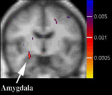% Change Reactivity of the amygdala in PTSD 3.5 3.0 2.5 2.0 1.5 1.0 0.