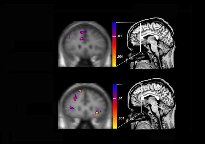 Reduced anterior cingulate function in PTSD (an fmri study)