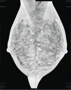 Increase reading productivity Accelerate the process Enhanced left-right symmetry with breast tissue alignment Reduced