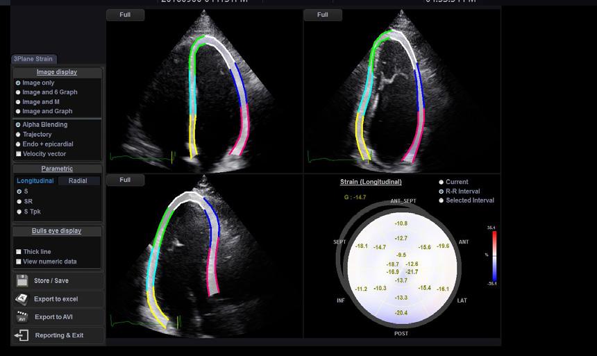 It allows easy intima-media thickness measurement of both the anterior and posterior wall of the common carotid