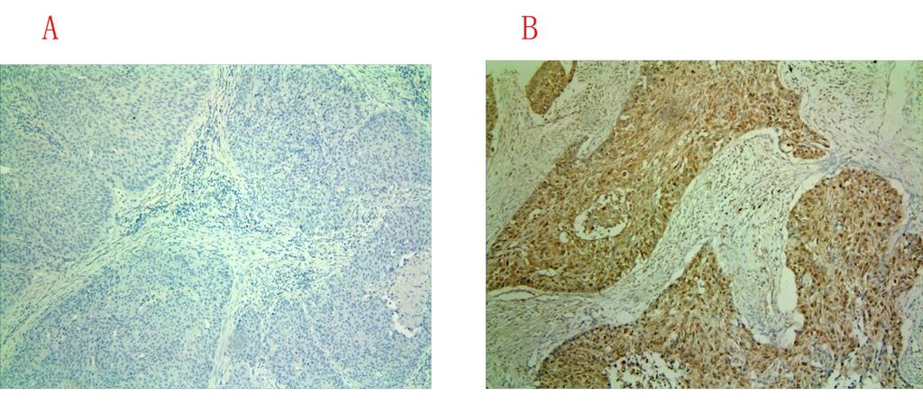 images for BTBD7-negative and -positive expression of were shown in Figure 2. In total 93 patients, 38 cases were found to be positive BTBD7 expression and 55 were negative BTBD7 expression.