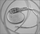 Review of Pacemakers and ICD Therapy: Overview and Patient Management