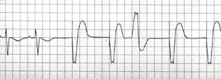 Capture Paced Ventricular