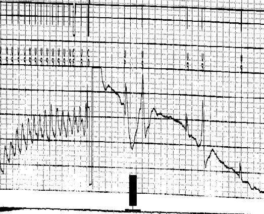 anterior / posterior if possible ICD Function EFFECTS OF ELECTROCAUTERY Reprogramming Permanent damage to the pulse generator Inhibition of the pulse generator Reversion to a fall-back*, noise