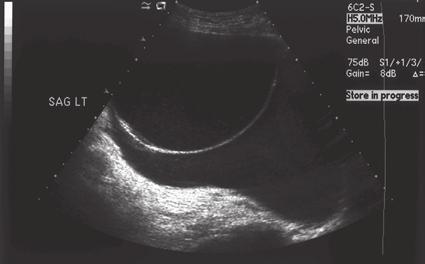 10 Chapter 1: Ultrasound Nomenclature Complex Cyst Anechoic, smooth walled, with posterior enhancement Septations that appear as echogenic hair-like strands within mass (Figure 1-12) Multilocular