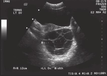 Ultrasound Description of Masses 11 UB U * * * * * * * * Figure 1-13 Complex Cyst.