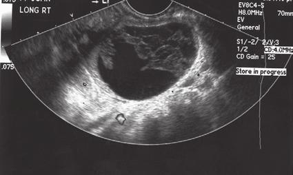 this is characteristic of a multilocular cyst due to the absence of solid components and absence of irregularities. Urinary bladder (UB), uterus (U). * * C * * Figure 1-14 Complex cyst.
