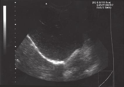 16 Chapter 1: Ultrasound Nomenclature Figure 1-16E (E) TGC with near gain greatly decreased. The anterior aspect of the liver is poorly visualized because of the loss of echoes in the near field.