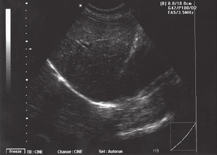 Figure 1-18C (C) Placement of the focal setting around mid depth of the liver demonstrates increased resolution in the near and midfield, but there is a