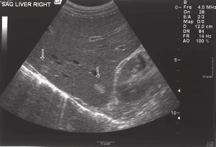 Also, note the anechoic fluid (arrows) representing a right-sided pleural effusion. K Figure 1-3 Hyperechoic and isoechoic.