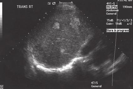 Ultrasound Artifacts 5 Figure 1-5 Inhomogeneous. A transabdominal transverse image of the right lobe of the liver ().