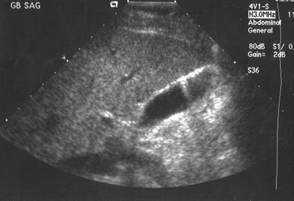 reverberation (arrows) artifacts. Note the minimal amount of fluid (fl) in the posterior cul-de-sac posterior to the uterus (U).
