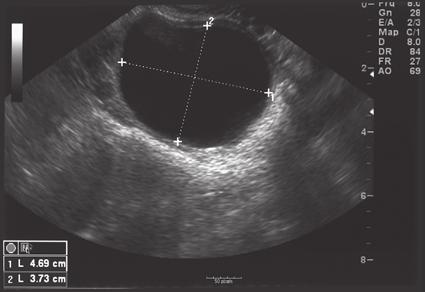 Ultrasound Description of Masses 9 Air-filled bowel loops near the gallbladder can mimic gallstones (see Chapter 3).