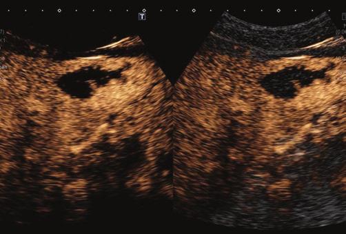 ultrasound (CEUS) imaging and quantification