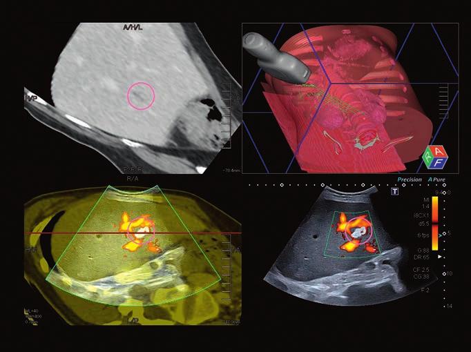 Smart Fusion merges realtime ultrasound with previously acquired CT, MR or ultrasound data, allowing you to identify and compare lesions with ease and to navigate complex anatomy