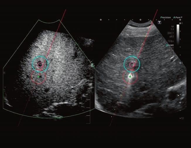 Color-coded virtual biopsy lines make it easy to track needles in both the live ultrasound and the adjacent