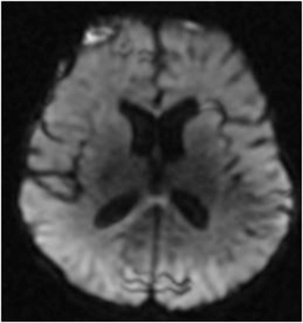 Fig. 5: Subdural bifrontal collections with
