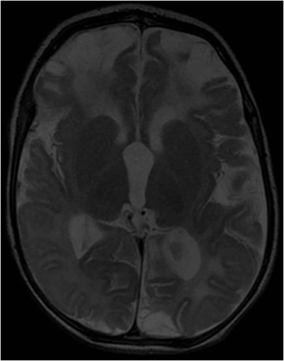 Fig. 10: 6 months MRI follow up: