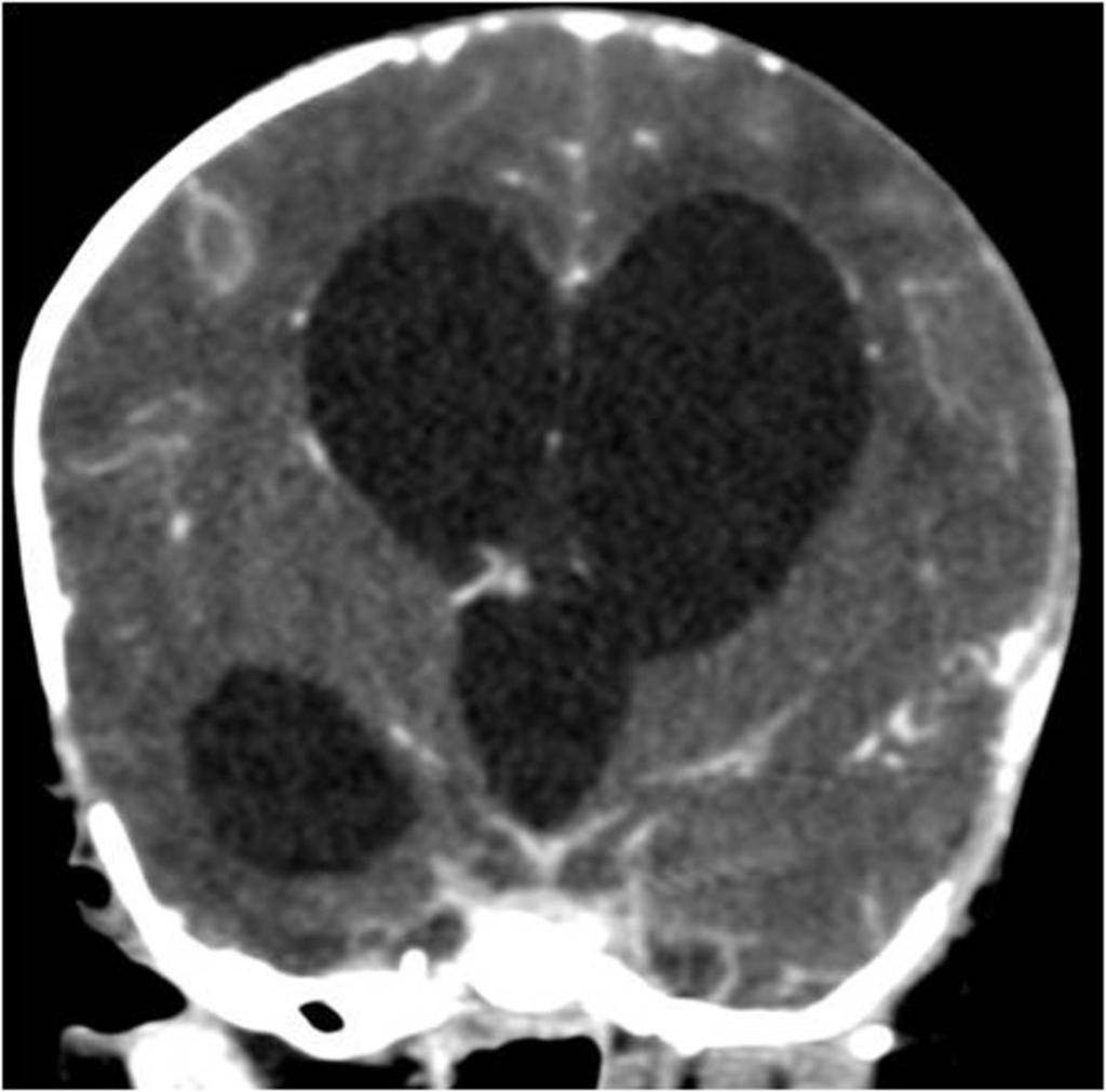 Fig. 11: Triventricular hydrocephaly