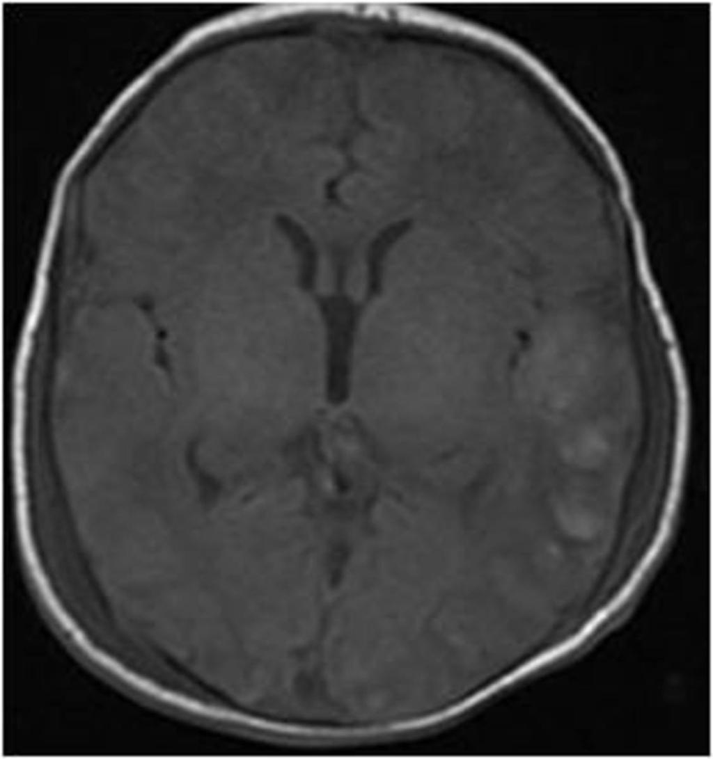 Fig. 7: diffuse cortical abnormalities on axial T1 weighted
