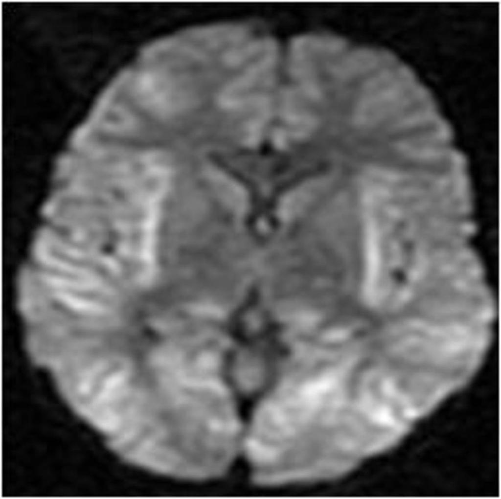 Fig. 16: Newborn with enterovirus menningoencephalitis:axial diffusion weighted image: