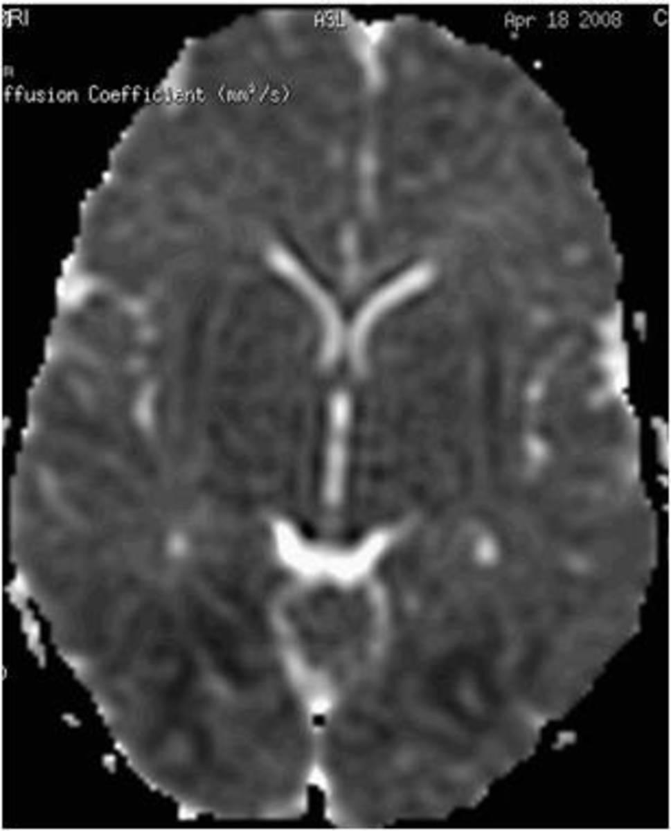 Fig. 17: Newborn with enterovirus menningoencephalitis:axial diffusion weighted image: