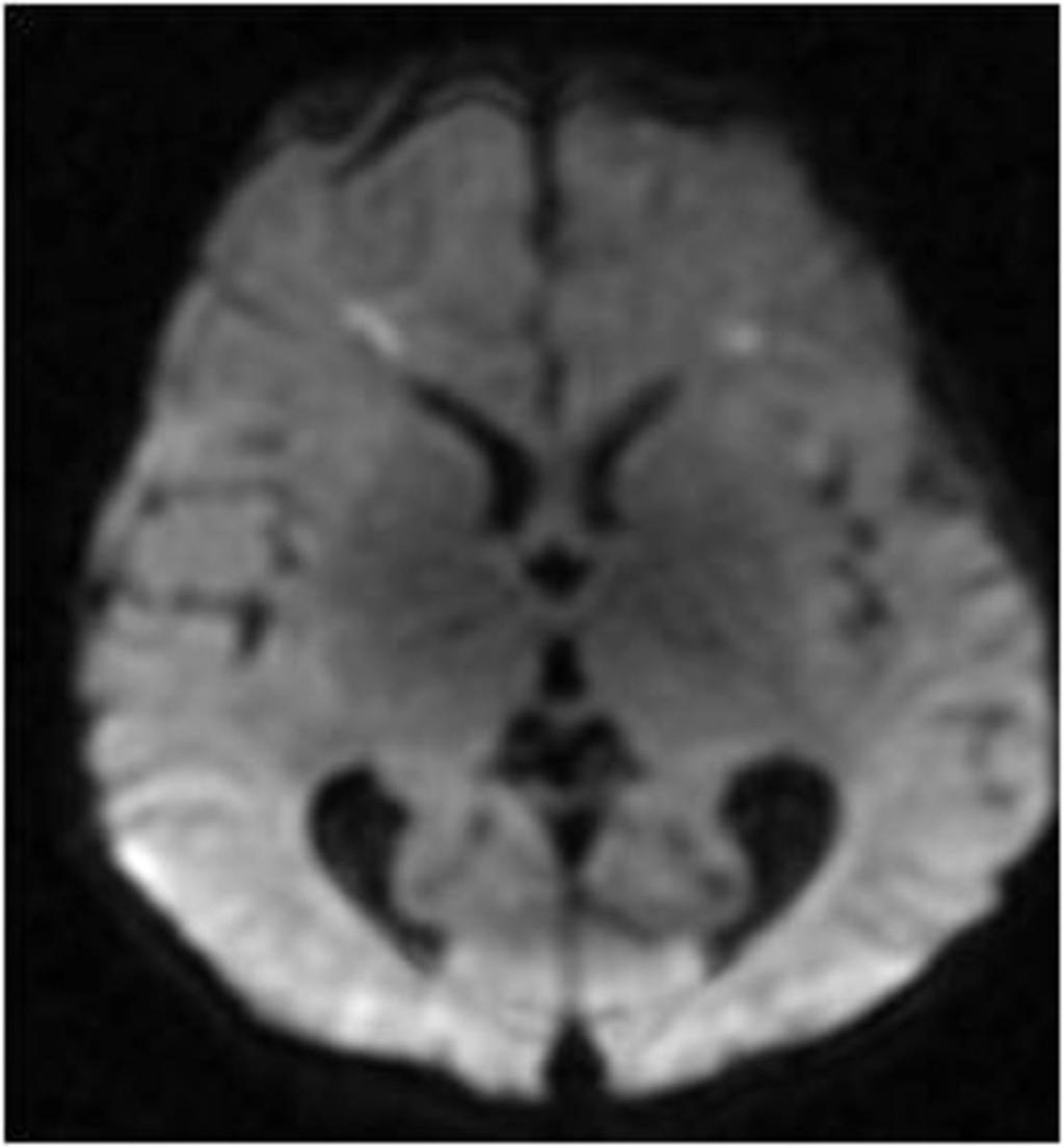 Fig. 1: periventricular puntuate infarcts