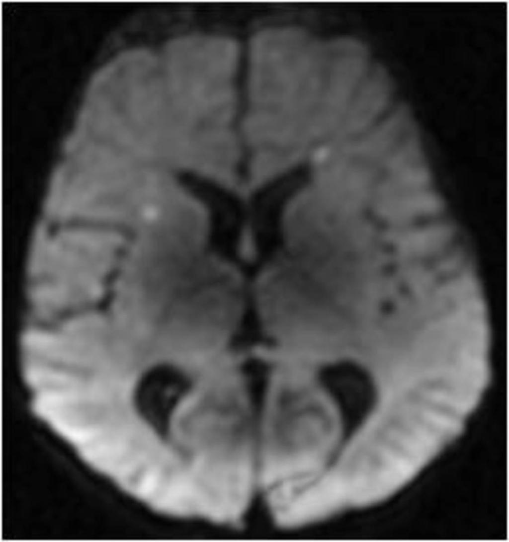 Fig. 2: periventricular puntuate infarcts
