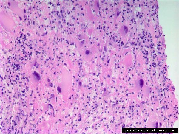 PML JCV- human papova virus Latent in renal tubuloepithelium; 60% of